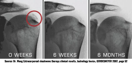 Chiropractic Laguna Hills CA Dr Wang Shockwave Therapy Results