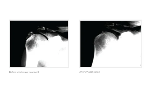 Chiropractic Laguna Hills CA Shockwave Before and After