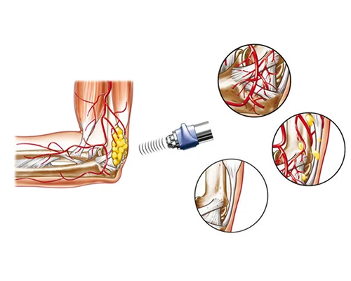 Chiropractic Laguna Hills CA Shockwave For Elbow