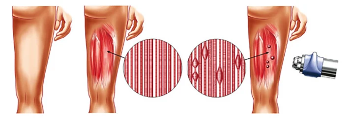 Chiropractic Laguna Hills CA Shockwave Therapy Leg Chiropractic Laguna Hills CA Shockwave Therapy Leg